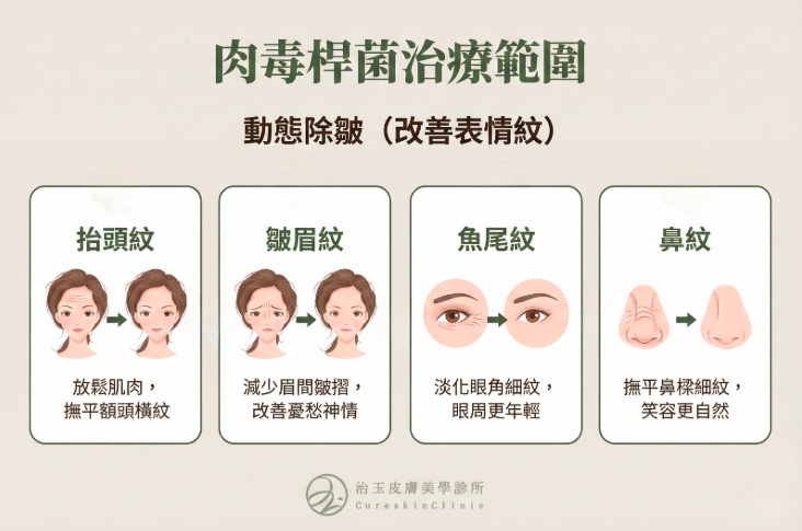 毒桿菌可動態除皺改善表情紋