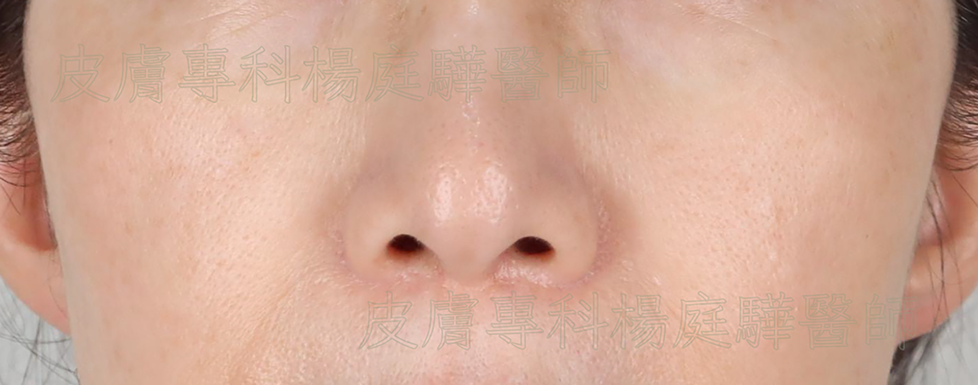 皮秒聚焦探頭治療後