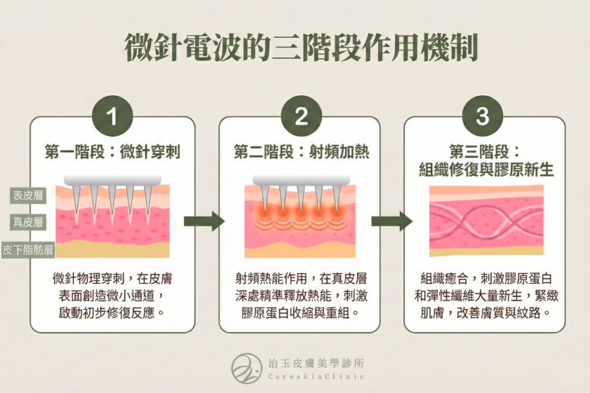 微針電波的三階段作用機制