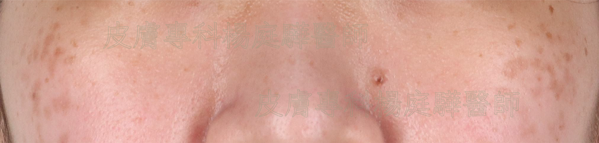 顴骨母斑:皮秒雷射治療前