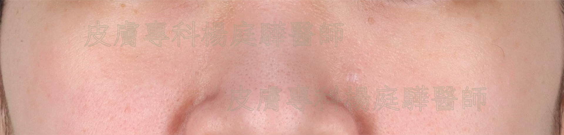 皮秒雷射治療後
