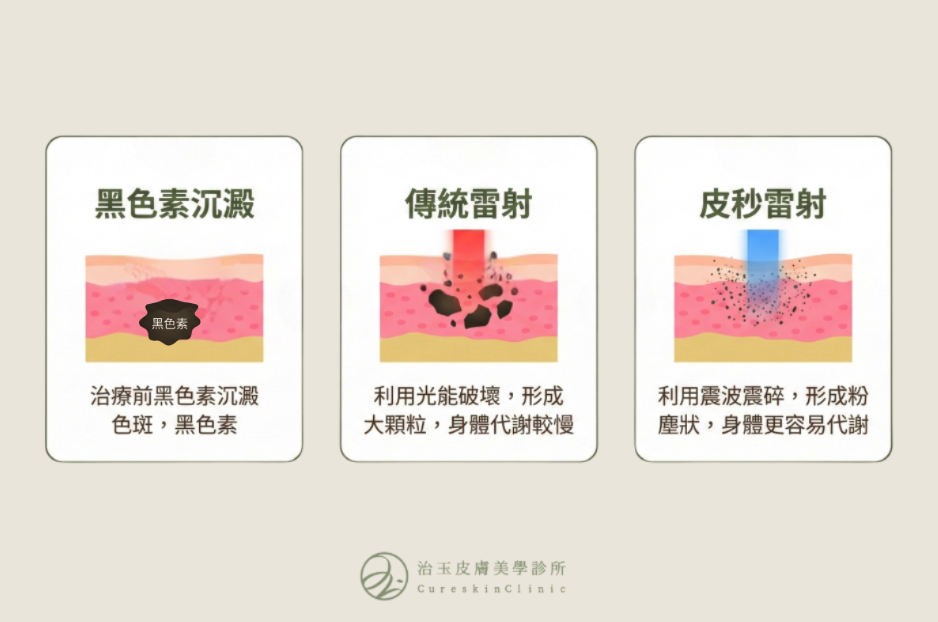 皮秒雷射是新世代精準除斑技術