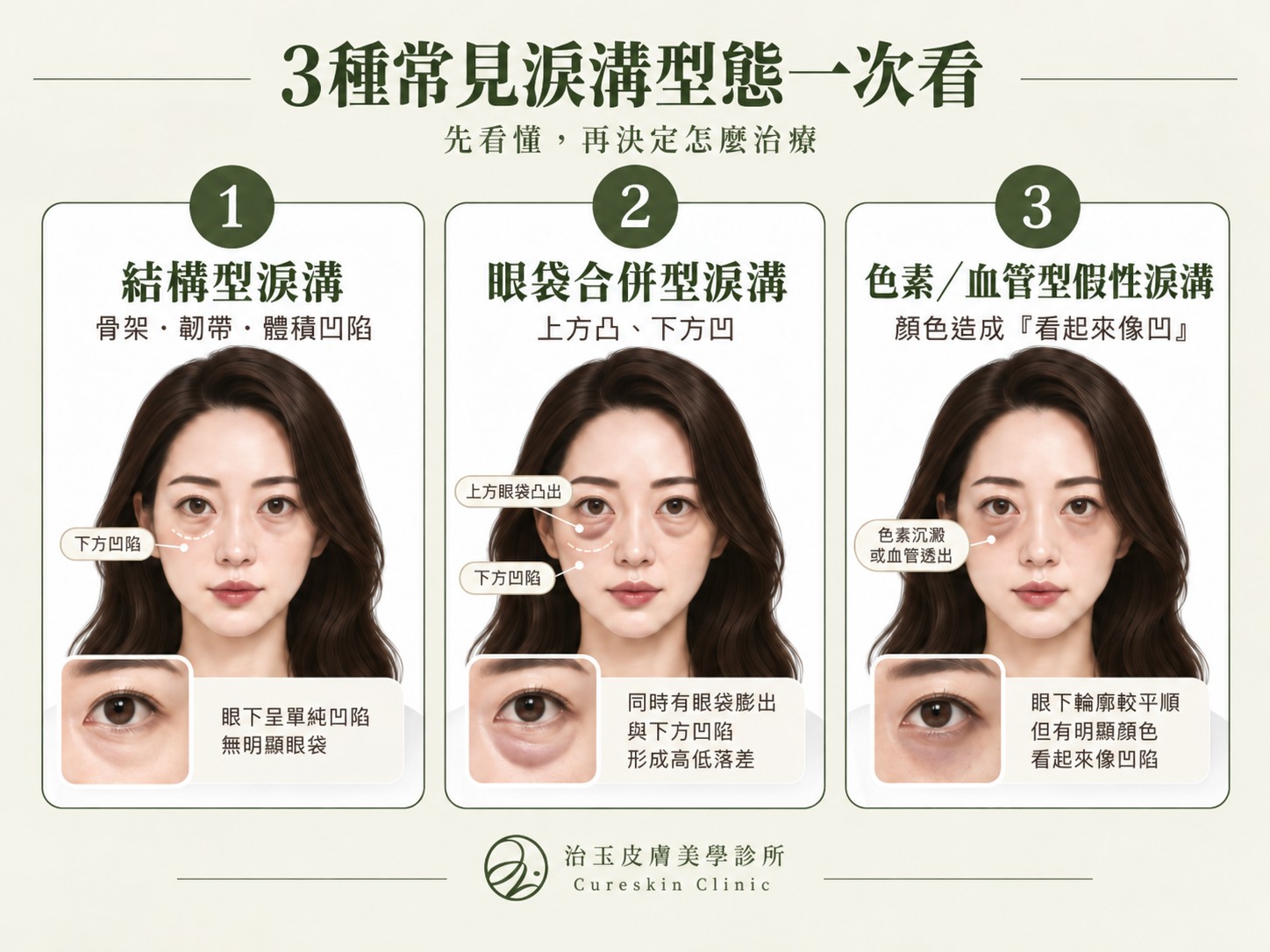 三大淚溝類型一次看