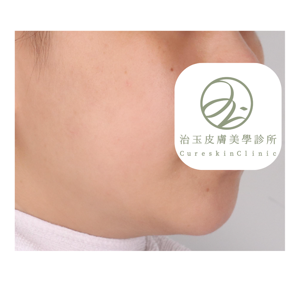 鳳凰電波治療前