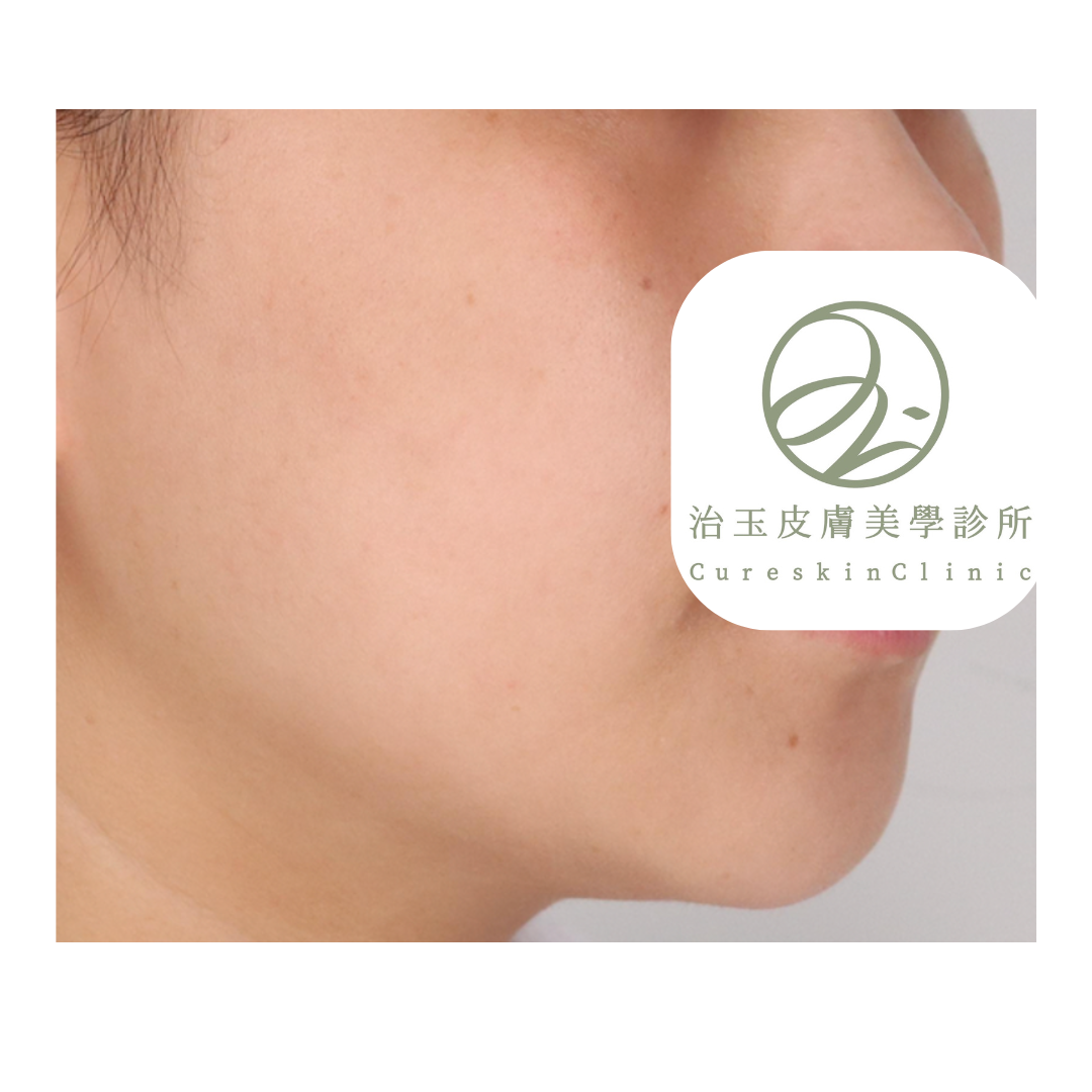 鳳凰電波治療後