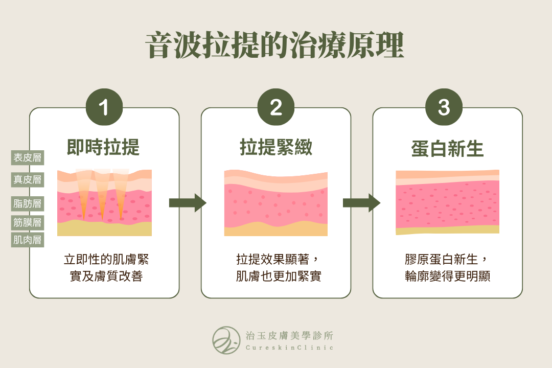 音波拉提的治療原理